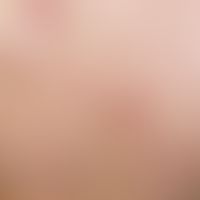 Pityriasis lichenoides et varioliformis acuta. acutely occurring "colorful" exanthema after febri...
