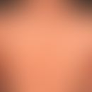 Pityriasis lichenoides et varioliformis acuta: Following an unclear febrile infection acutely occ...