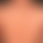 Pityriasis lichenoides et varioliformis acuta: Following an unclear febrile infection acutely occ...
