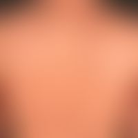 Pityriasis lichenoides et varioliformis acuta: Following an unclear febrile infection acutely occ...