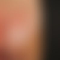 Pityriasis rosea:&nbsp;gereizte, „irritierte“, auch&nbsp;"ekzematisierte" Form der Pityriasis ros...
