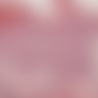 Pityriasis rosea:&nbsp;deutliche Akanthose,&nbsp;fokale Spongiose und Parakeratose;&nbsp;schütter...