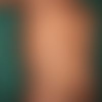 Pityriasis rosea:&nbsp;deutlich sichtbares&nbsp;Primärmedaillon in der rechten Axilla. Die nur le...