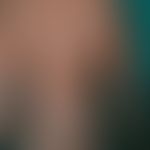 Pityriasis rosea in dark skin. A few weeks old, slightly itchy, bran-like scaly exanthema in a yo...