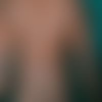 Pityriasis rosea in dunkler Haut:&nbsp;wenige Wochen bestehendes, wenig juckendes, kleieförmig sc...