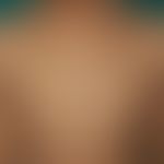 Pityriasis rosea: A maculo-papular to plaque-like, slightly to moderately scaly exanthema with co...