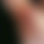 Pityriasis rubra pilaris, multiple, chronically dynamic (changing course; worsening in summer), c...