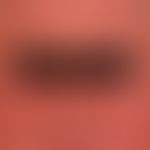 Pityriasis rubra pilaris (adult type): relapsing, eythrodermic maximum variant of pityriasis rubr...