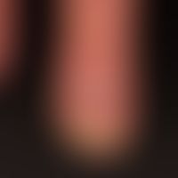 Pityriasis rubra pilaris. Chronic, non-specific onychodystrophy. Complete loss of cuticle. Distal...