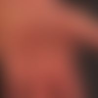 Pityriasis rubra pilaris. Diffuse&nbsp;Keratosis plamaris&nbsp;et plantaris (Palmo-Plantarkeratos...