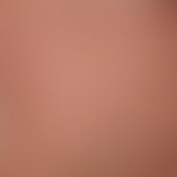 Piytriasis rubra pilaris: Nappes claires
