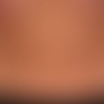 Pityriasis versicolor:&nbsp;groß- und kleinflächige,&nbsp;wenig schuppende, nur gelegentlich leic...