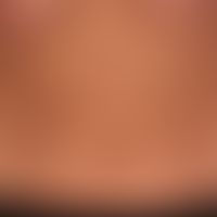 Pityriasis versicolor: largeand small, little scaly, only occasionally slightly itchy, bright, bi...