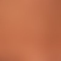 pityriasis versicolor alba. large and small, slightly scaly, brown, bizarrely configured bright s...
