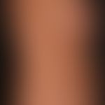 Pityriasis versicolor. Groß- und kleinflächige,&nbsp;wenig schuppende, nur gelegentlich leicht ju...