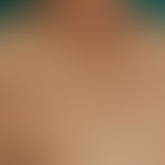 Pityriasis versicolor: wie ausgestreut wirkende, unregelmäßig konfigurierte, symptomlose braune&n...