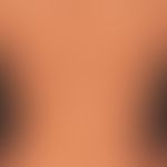 Pityriasis versicolor alba. Depigmentierungen nach abgeheilter Infektion.

