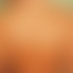 Pityriasis versicolor alba. 17-jährige Patientin, die nach einem Sommerurlaub diese weißen Flecke...