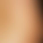 Pityriasis versicolor alba: Nahaufnahme, spritzerartige und feinfleckige Depigmentierungen mit fe...