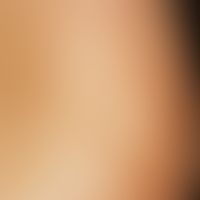 Pityriasis versicolor alba: Close-up, spatter-like and fine spotted depigmentation with fine surf...