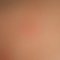 Malasseziafolliculitis: multiple, acute, disseminated, follicle-bound, 0.2-0.6 cm large, inflamma...