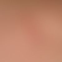 Malasseziafolliculitis: follicle-bound, 2-6 mm large, inflammatory papules and papulopustules on ...
