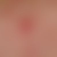 Malasseziafolliculitis, detail magnification: In the picture, almost centrally located, a follicl...