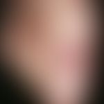 Podagra. acute, very painful, red swelling in the area of the big toe joint with hyperuricemia. a...