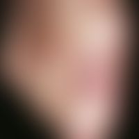 Podagra. acute, very painful, red swelling in the area of the big toe joint with hyperuricemia. a...