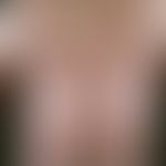 Poikilodermia vascularis atrophicans. 63 Jahre alter Patient mit seit 20 Jahren bestehendem, lang...