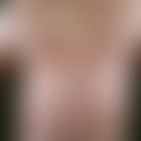 Poikilodermia vascularis atrophicans. 63 Jahre alter Patient mit seit 20 Jahren bestehendem, lang...