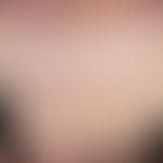 Poikiloderma, actinic. actinic keratoses tinged brownish due to increased pigment formation with ...