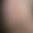 Polychondritis recidivans et atrophicans. 1 year old ?washcloth ears? combined with saddle nose i...