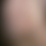 Polychondritis recidivans et atrophicans. Seit 1 Jahr bestehende ?Waschlappenohren?, kombiniert m...