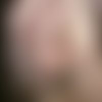 Polychondritis recidivans et atrophicans. Seit 1 Jahr bestehende ?Waschlappenohren?, kombiniert m...