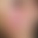 Polycythaemia vera. multiple, chronically stationary (no flush symptoms), symmetrical, blurred, s...