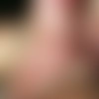Polydactyly, rudimentary. chronic stationary, congenital, pea-sized, hard, skin-colored to reddis...