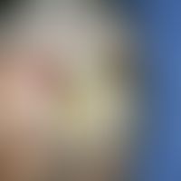 Pomadenkruste. Cornu-cutaneum-artige&nbsp;Hornschichtverdickung bei einer älteren, pflegebedürfti...