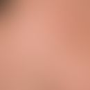 Porokeratosis linearis unilateralis; first occurred 5 months ago; since then persistent, non-prur...