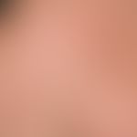 Porokeratosis linearis unilateralis:&nbsp;vor 5 Monaten erstmals aufgetretene, seitdem persistier...