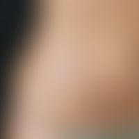 Porokeratosis linearis unilateralis: Multiple, chronically stationary, first appeared 2 years ago...