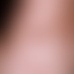 Porokeratosis Mibelli. gradually progressive finding with solitary, 0.1-0.2 cm large, symptom-fre...