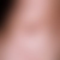 Porokeratosis Mibelli. gradually progressive finding with solitary, 0.1-0.2 cm large, symptom-fre...