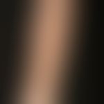 Porokeratosis superficialis disseminata actinica: Disseminated, reddened, marginalized papules up...
