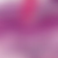 Porokeratosis superficialis disseminata actinica. Orthohyperkeratose mit fokaler (fahnenartiger) ...
