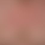 Porokeratosis superficialis disseminata actinica, a progressive, symptomless, disseminated, eryth...