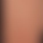Porokeratosis superficialis disseminata actinica, overview: Chronically active, multiple, dissemi...