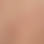 Porokeratosis superficialis disseminata actinica, detail section: Several disseminated, erythemat...