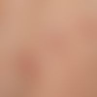 Porokeratosis superficialis disseminata actinica. Detailausschnitt: Mehrere, disseminierte, eryth...