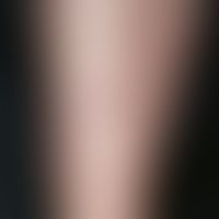 Porokeratosis superficialis disseminata actinica. Asymptomatische, am Unterschenkel lokalisierte,...